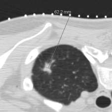 Figure 42.4, Axial noncontrast CT image obtained after angulating the gantry by 10 degrees cephalad shows a clear path to the biopsy target. The distance from skin to target is 6.2 cm, and the operator can choose the appropriate length of introducer needle at this time.