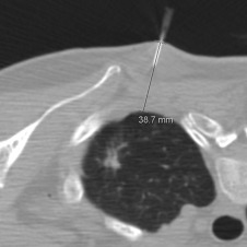 Figure 42.5, Axial noncontrast CT image shows a clear path between the skin entry site, marked by the local anesthesia needle and biopsy target. Note that the distance to pleura measures 3.7 cm.