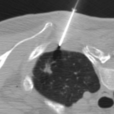 Figure 42.6, Axial noncontrast CT image shows the introducer needle well anchored in the soft tissues, with the tip just short of the pleura. The introducer needle is well aligned with the biopsy target.