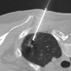 Figure 42.7, Axial noncontrast CT image shows the introducer in the lung parenchyma short of the lesion. Note the air bubble adjacent to the parietal pleura, indicating that pleural anesthetic was injected into the intended plane.