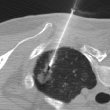 Figure 42.8, Axial noncontrast CT image shows the introducer needle in the target. New ground-glass opacities around the target reflect a small amount of hemorrhage, expected after fine-needle aspiration.