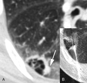 Figure 42.9, (A) Axial contrast-enhanced CT image shows a cystic right lower lobe lesion with a dominant wall nodule (arrow). (B) Biopsy of the nodule revealed adenocarcinoma. Ground-glass opacities around the target represent an expected small amount of biopsy-related hemorrhage.