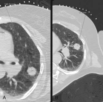 Figure 42.10, Axial noncontrast enhanced CT images demonstrate an anterior approach to a left upper lobe nodule located anterior to the major fissure. (A) With the patient supine, the path was longer and came closer to larger vessels compared to the patient tilted obliquely by 45 degrees (B) using a rolled-up blanket.
