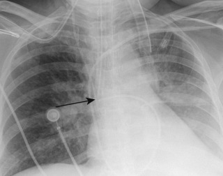 FIGURE 9.1, Right mainstem intubation. Anteroposterior chest radiograph shows the tip of the endotracheal tube (arrow) beyond the carina in the distal right mainstem bronchus. There is associated atelectasis of the left lower lobe.