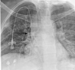 FIGURE 9.11, Catheter in the right internal mammary vein. Anteroposterior chest radiograph shows that the right-sided central venous catheter (CVC) is focally curved (arrow) at the level of the superior vena cava (SVC) and lies lateral to the SVC (extracaval). Normally, CVCs overlie the SVC and are not focally curved at this location. The focal curve and extracaval course have been termed the “extracaval shepherd's crook sign” and is a characteristic radiographic sign of right internal mammary vein catheter placement.