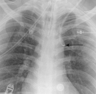 FIGURE 9.12, Catheter in the left superior intercostal vein. Anteroposterior chest radiograph shows that the left central venous catheter is curved lateral to the aortic arch (arrow) in the left superior intercostal vein.