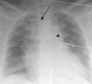 FIGURE 9.13, Arterial placement of right central venous catheter (CVC). Anteroposterior chest radiograph shows the right subclavian CVC courses superiorly away from the medial right first rib (arrow) and crosses the midline with the distal tip over the aortic arch (arrowhead) . The catheter follows the arterial course of the right subclavian artery and right brachiocephalic artery to the aorta.