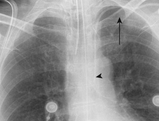 FIGURE 9.14, Arterial placement of left central venous catheter (CVC). Anteroposterior chest radiograph shows that the left subclavian CVC extends above the left clavicle (arrow) , descends overlying the left subclavian artery, fails to cross the midline, and terminates over the aorta (arrowhead) . The catheter is in the left subclavian artery and aorta.