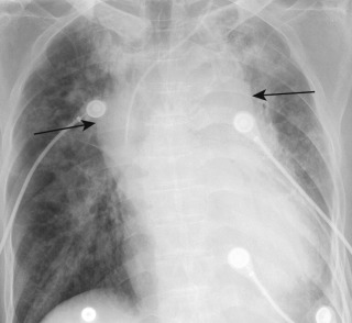 FIGURE 9.15, Mediastinal hematoma after central line placement. After difficult insertion of the left central venous catheter, an anteroposterior chest radiograph shows acute mediastinal widening (arrows) consistent with a mediastinal hematoma confirmed on computed tomography (not shown).