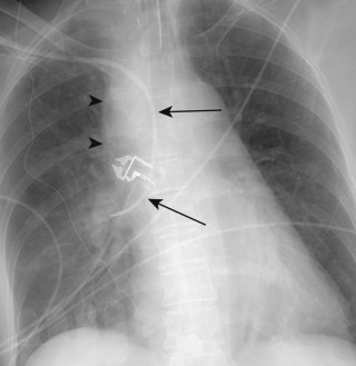 FIGURE 9.16, Extravascular catheter. Anteroposterior chest radiograph shows the right subclavian central venous catheter has a bizarre course (arrows) that does not conform to thoracic venous or arterial anatomy. There are acute thickening and increased density of the right paratracheal stripe consistent with hematoma (arrowheads) . The findings are consistent with an extravascular catheter with associated right paratracheal hematoma.