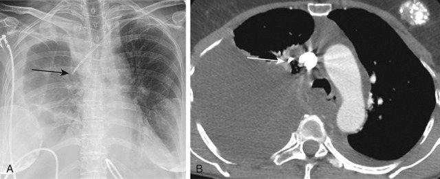 FIGURE 9.17, Catheter perforation of the superior vena cava (SVC) and infusothorax. A, Anteroposterior chest radiograph shows a left subclavian central venous catheter with distal tip lateral to the margin of the SVC (arrow) . There is a large right pleural effusion that increased in size after intravenous (IV) fluid infusion. B, Axial image from contrast-enhanced chest computed tomography shows the distal tip of the catheter external to the SVC (arrow) and a large low-density right pleural effusion from infusion of IV fluid into the pleural space (infusothorax).