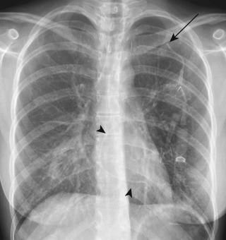 FIGURE 9.18, Catheter fracture with catheter fragment in the right heart. Posteroanterior chest radiograph shows fracture of the left-sided port catheter between the left first rib and clavicle (arrow) and a catheter fragment in the right heart (arrowheads) . The catheter fracture is likely the result of compression of the catheter between the first rib and clavicle, the catheter “pinch-off syndrome.”