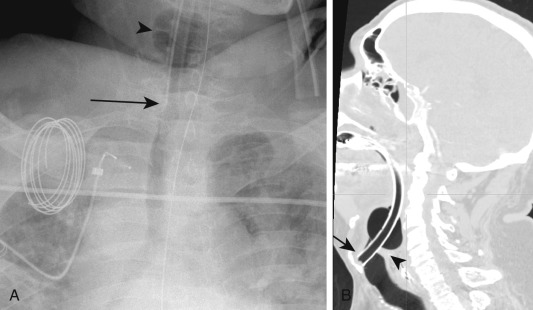 FIGURE 9.2, High endotracheal tube. A, Anteroposterior chest radiograph shows the tip of the endotracheal tube (ETT) (arrow) at the level of T1 measuring 11.5 cm above the carina. The ETT balloon cuff is overinflated (arrowhead) . B, Sagittal reconstruction from concurrent neck computed tomography scan in the same patient shows the ETT tip (arrow) just below the vocal cords (arrowhead) . The ETT cuff balloon is overdistended in the hypopharynx and is above the vocal cords.