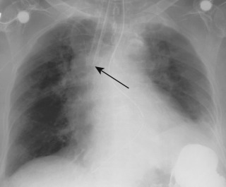 FIGURE 9.3, Tracheal rupture. Anteroposterior chest radiograph illustrates the radiographic findings of tracheal rupture, including overdistention of the endotracheal tube (ETT) cuff balloon, shortening of the distance from the balloon cuff to the distal tip (arrow) , and deviation of the ETT to the right. The ETT has perforated the wall of the trachea, and the distal ETT and cuff balloon reside in the right superior mediastinum. The distended cuff occluded the perforation of the trachea. When the ETT was removed, pneumomediastinum developed (not shown).