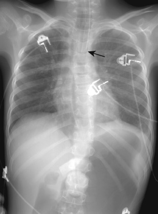 FIGURE 9.4, Esophageal intubation. Anteroposterior chest radiograph shows the endotracheal tube (arrow) external and to the left of the trachea with air distention of the esophagus and stomach.