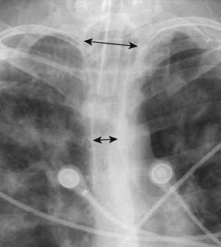 FIGURE 9.5, Overdistended endotracheal tube (ETT) balloon cuff. Anteroposterior chest radiograph shows the ETT cuff balloon diameter (upper arrow) exceeds twice the diameter of the normal trachea (lower arrow) . When the ratio of the width of the ETT balloon cuff to the width of the trachea exceeds 1.5, tracheal injury is more likely.