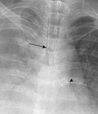 FIGURE 9.6, Double-lumen endotracheal tube (ETT). Anteroposterior chest radiograph shows a double-lumen ETT with right lung ventilation port in the trachea (arrow) and left lung ventilation port in the distal left mainstem bronchus (arrowhead) .