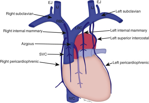 FIGURE 9.7, Thoracic venous anatomy. The lateral margin of the first rib is the demarcation between the axillary vein (extrathoracic) and the subclavian vein (intrathoracic). The subclavian veins join with the internal jugular (IJ) veins to form the brachiocephalic veins (left and right BCV). The brachiocephalic veins join to form the superior vena cava (SVC). The small thoracic veins that flow into the BCVs are illustrated, including the internal thoracic (internal mammary) veins, left superior intercostal vein, and pericardiophrenic veins. The azygous vein ascends into the mediastinum and extends over the right mainstem bronchus to insert into the posterior aspect of the superior vena cava. EJ, external jugular vein; LBC, left brachiocephalic vein; RBC, right brachiocephalic vein.