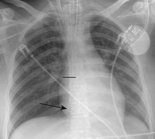 FIGURE 9.8, Central line in the right atrium. Anteroposterior chest radiograph shows a right central venous catheter extending beyond the superior cavoatrial junction (demarcated by a horizontal line ) with its distal tip in the inferior right atrium (arrow) .