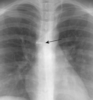 FIGURE 9.9, Catheter in the azygous vein. Anteroposterior chest radiograph shows the left internal jugular catheter tip is curved into the azygous vein (arrow) . The catheter extends from the superior vena cava into the azygous vein and extends posteriorly into the azygous arch.