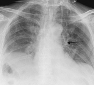 FIGURE 9.10, Catheter in the left internal mammary vein. Anteroposterior chest radiograph shows that the left-sided central venous catheter fails to cross the midline and terminates over the left hilum (arrow) . The appearance is consistent with placement in the left internal mammary vein, which was confirmed on chest computed tomography (not shown).