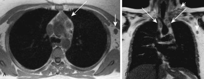 FIGURE 3.1, “No-dose imaging”: a 29-year-old woman with Hodgkin disease in need of staging while pregnant. A and B, Axial in-phase T1-weighted image and coronal single-shot fast spin-echo T2-weighted image show anterior mediastinal (long arrows) , left axillary (medium-sized arrows) , and left supraclavicular (short arrow) lymphadenopathy.