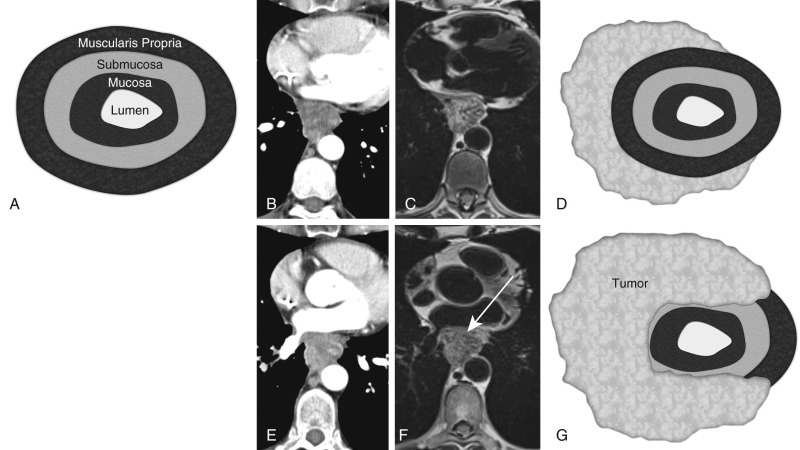 FIGURE 3.3, Detection of invasion: subcarinal metastatic bladder cancer invading the esophagus. A, Artistic rendering showing the correlative names for the various high- and low-signal layers of the esophagus. Matched axial computed tomography (CT) (B) and axial cardiac-gated (CG) double inversion recovery (IR) T2-weighted (C) magnetic resonance images (MRIs) and artistic rendering (D) of an amorphous heterogeneous attenuation mass on CT, effacing the fat plane between it and the right half of the esophageal wall. The presence of esophageal wall invasion by the mass is indeterminate by CT. Correlative T2-weighted MRI and artistic rendering reveal partial encasement of the esophagus by tumor without invasion through the laminar wall of the esophagus. Matched axial CT (E) and CG double IR T2-weighted (F) MR images and artistic rendering (G) of the mass at a higher level, again revealing partial encasement of the esophagus and effacement of the fat plane between these two entities on CT. T2-weighted MRI and rendering reveal effacement of a portion of the wall (muscularis propria and submucosa) of the esophagus (arrow) , compatible with invasion of these layers of the esophageal wall by tumor.