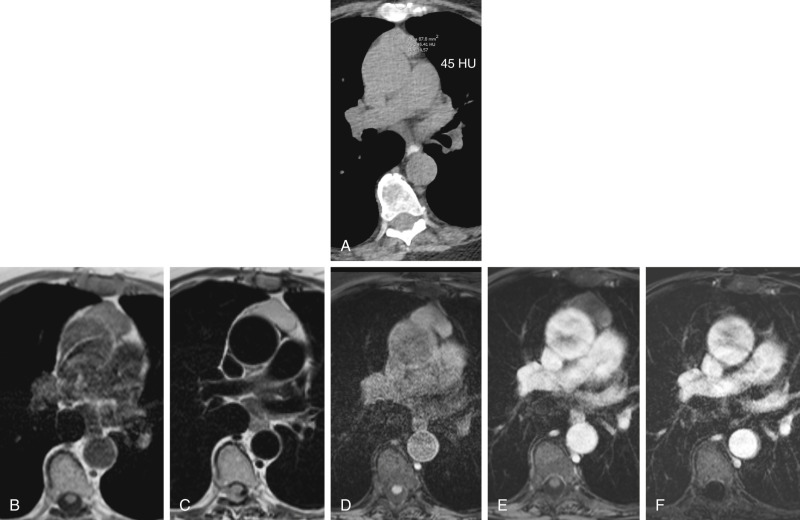 FIGURE 3.4, Distinction of cystic from solid lesions: indeterminate thymic mass on computed tomography (CT) characterized as a unilocular proteinaceous or hemorrhagic cyst by magnetic resonance imaging (MRI). A, Axial CT image shows a homogeneous attenuation, 45 HU (Hounsfield units) mass with saccular morphology filling much of the thymic bed. The differential diagnosis includes thymic hyperplasia, thymic cyst, thymic neoplasm, and lymphoma. B, Axial in-phase T1-weighted, C, Cardiac-gated double-inversion recovery T2-weighted, D, Precontrast ultrafast three-dimensional (3D) gradient echo (GRE), fat-saturated T1-weighted, E, Postcontrast ultrafast 3D GRE, fat-saturated T1-weighted, and F Postcontrast, postprocessed subtracted MR images, respectively, show the mass to be of intermediate T1 signal and homogeneously and markedly T2-hyperintense and to exhibit no internal enhancement, proving the mass to represent a thymic cyst. Thin smooth wall enhancement is present and commonly appreciable in thymic cysts by MRI, albeit seldom by CT.