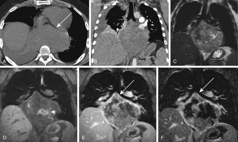 FIGURE 3.5, Magnetic resonance imaging (MRI) differentiates solid tissue from fluid in a mass, guiding biopsy for higher diagnostic yield: indeterminate hemorrhagic mass involving visceral mediastinum on computed tomography (CT), shown to be mixed solid and hemorrhagic–necrotic on MRI. Axial noncontrast (A) and coronal contrast-enhanced (B) CT images show amorphous, heterogeneous attenuation material in the visceral mediastinum, anteriorly displacing the heart and esophagus (short arrow) , with an adjacent or contiguous right pleural effusion and partial right lower lobe relaxation atelectasis. It is unclear by CT whether this finding represents pure hemorrhage or a hemorrhagic mass and, if a hemorrhagic mass, where its solid components are. C, Coronal single-shot fast spin-echo T2-weighted, D, Precontrast fat-saturated T1-weighted, E, Postcontrast ultrafast three-dimensional gradient echo, fat-saturated T1-weighted, F, Postcontrast, postprocessed subtraction MR images reveal the indeterminate CT finding to represent a large, well-circumscribed mediastinal mass of heterogeneous T1- and T2-weighted signal, with areas of T1-hyperintensity representing hemorrhage (e.g., short arrow ). The postcontrast image and, in particular, the subtraction image clearly delineate the solid, cellular, enhancing components of this mass that would be most promising for diagnostic biopsy, including a subcarinal solid component (long arrow) accessible to minimally invasive bronchoscopic needle biopsy.