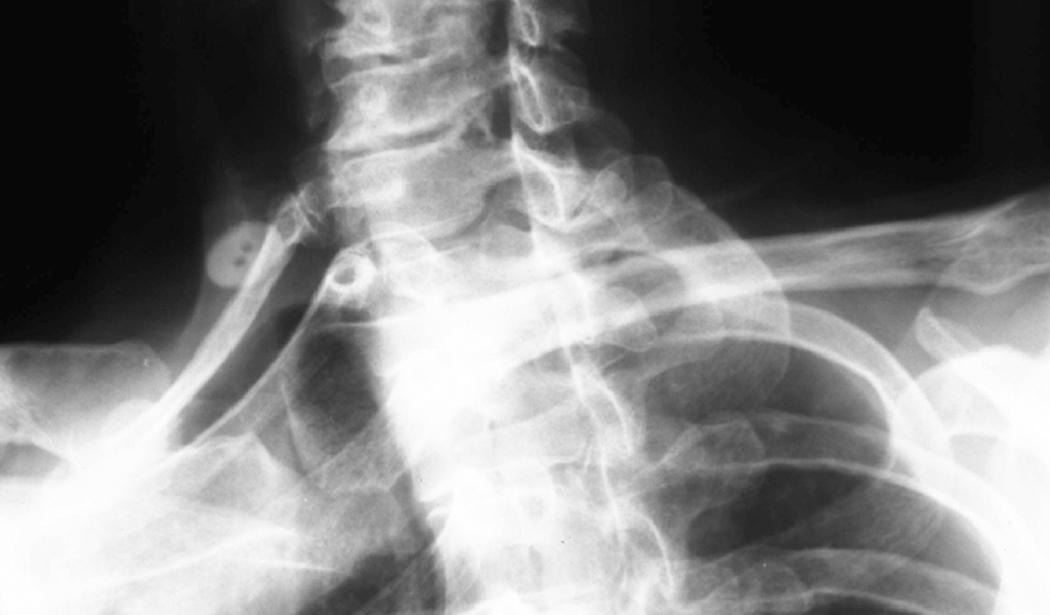 Fig. 29.1, An oblique radiograph of the cervical spine of a patient with a complete right cervical rib and vascular thoracic outlet syndrome (“button marks” on the rib).