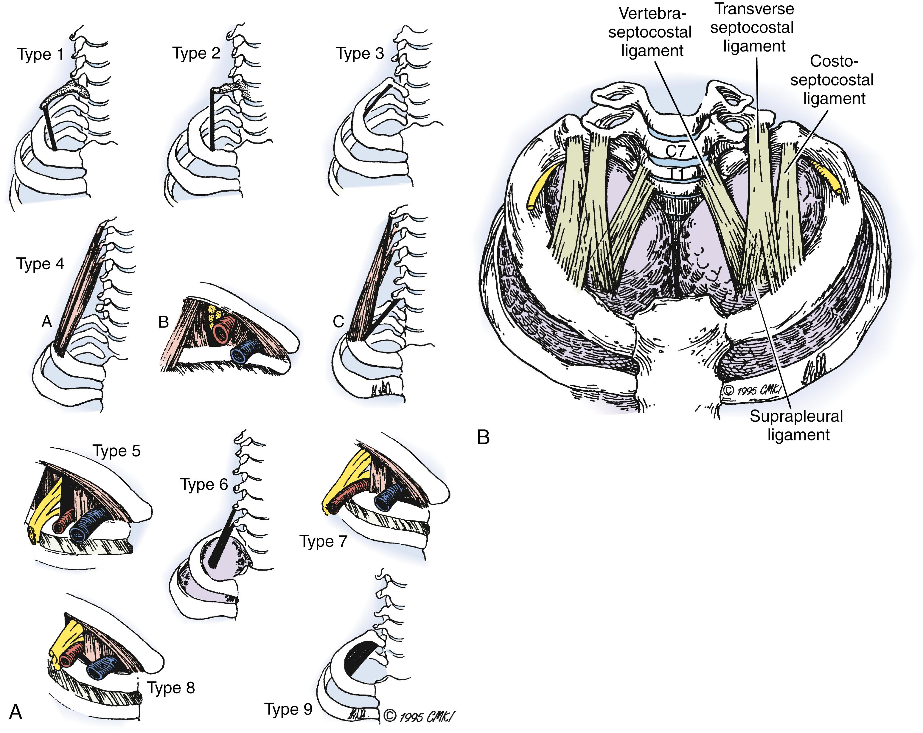 Fig. 29.7, A, Nine fibrous bands described by Roos 29 , 30 that may cause neurovascular compression in the thoracic outlet region. B, Three fibrous structures in the thoracic outlet described by Poitevin 32 that may cause neurovascular compression.