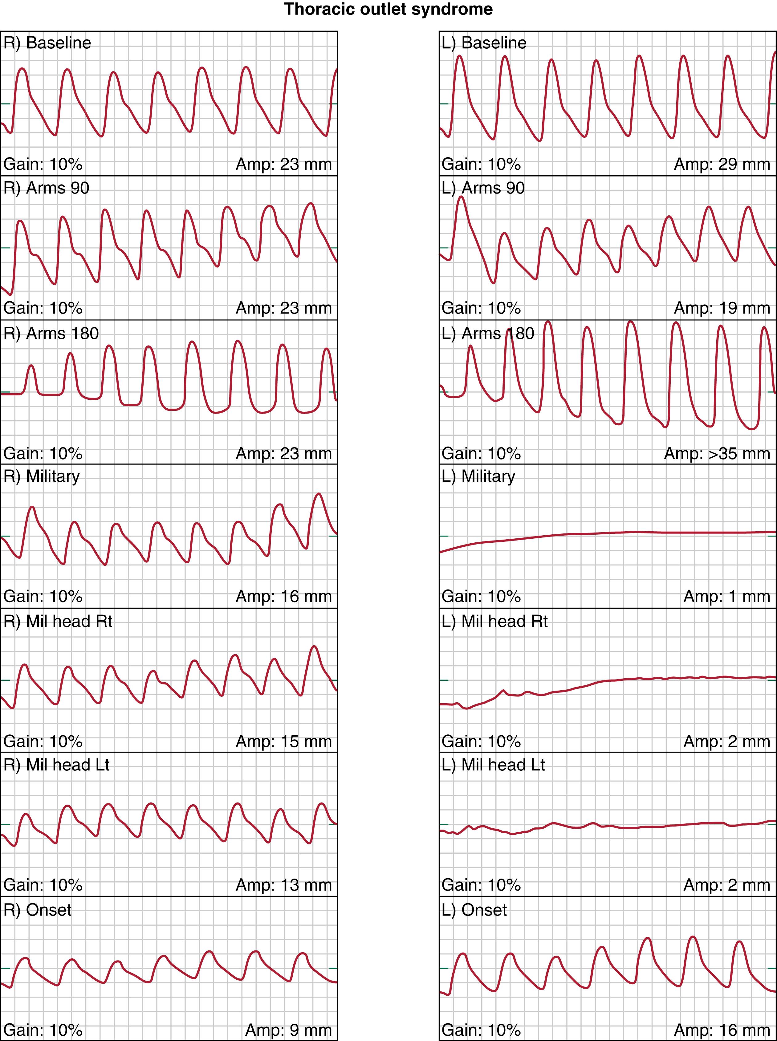 Figure 125.1, Digital photoplethysmography studies showing left upper extremity arterial waveform reduction with selected compression maneuvers.