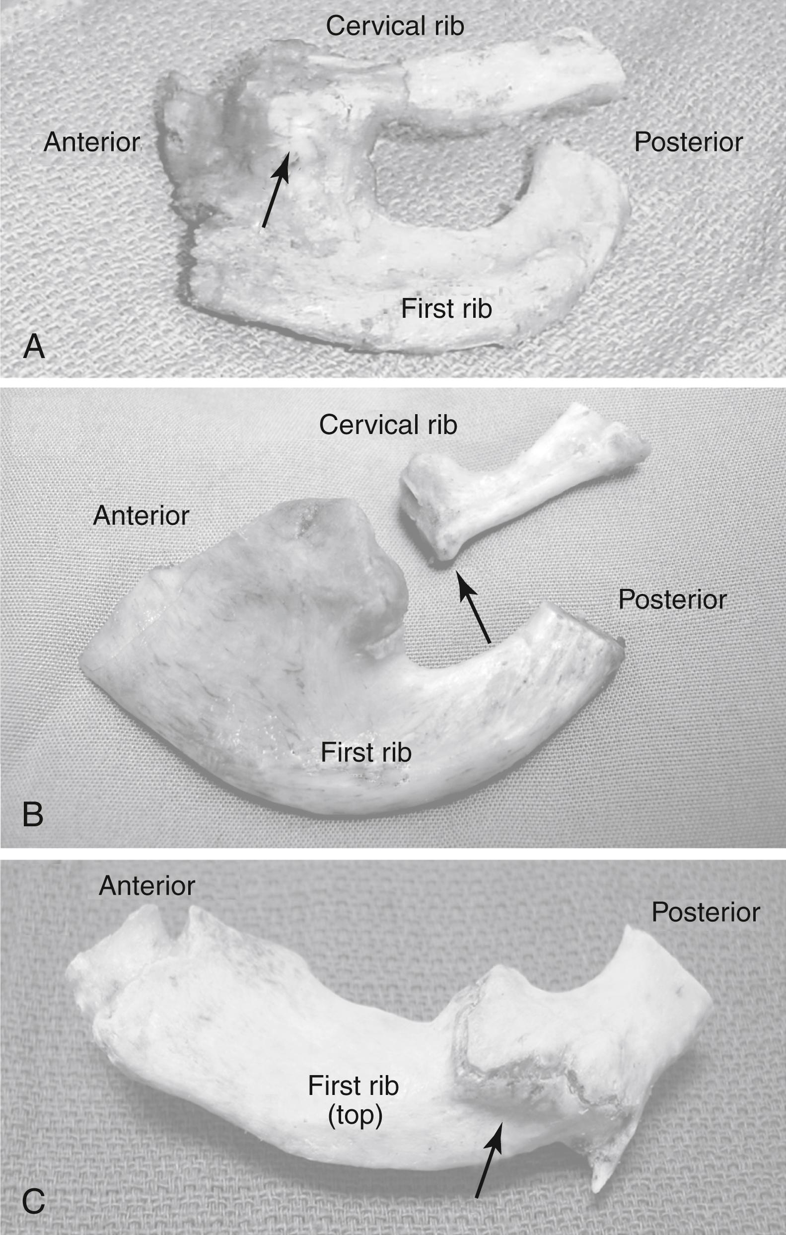 Figure 124.2, First Rib Anomalies.