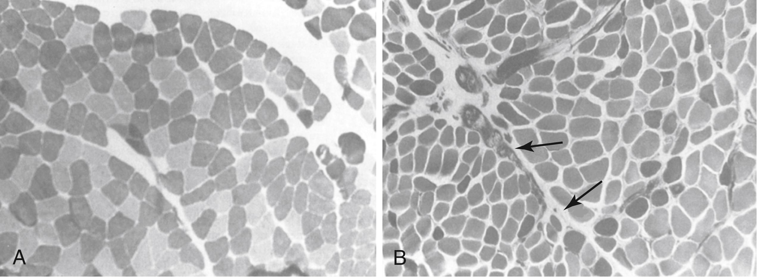 Figure 124.3, Scalene Muscle Histology in Neurogenic Thoracic Outlet Syndrome (nTOS).