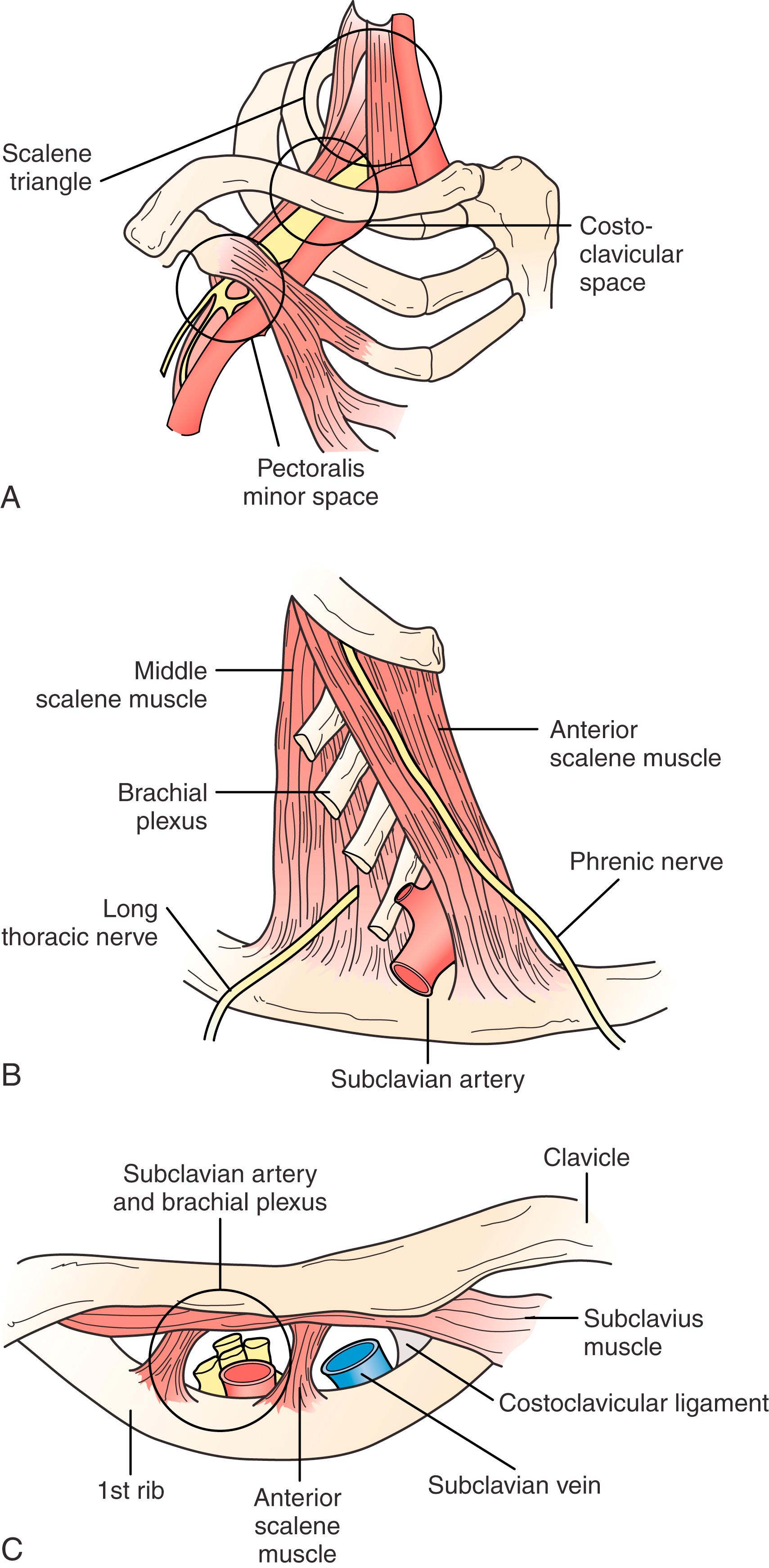 Figure 123.1, ( A ) Anatomy of the thoracic outlet with respect to the three major spaces. ( B ) Scalene triangle with the phrenic and long thoracic nerves located in the most common positions. ( C ) Costoclavicular space revealing the subclavian vein being separated by the anterior scalene muscle from the subclavian artery and brachial plexus.