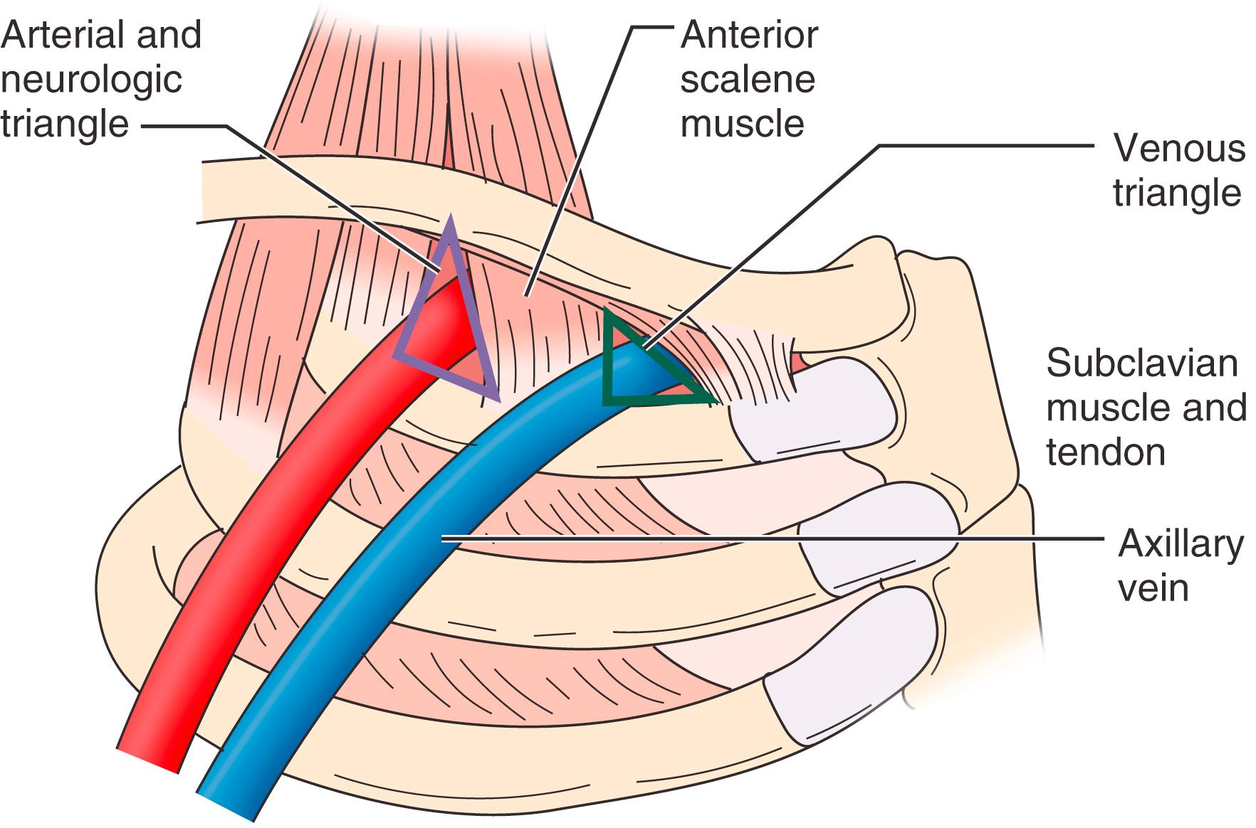 Figure 123.2, Anatomic triangles of the thoracic outlet highlighting the location of the neurovascular structures. The subclavian artery and brachial plexus traverse the thoracic outlet through the scalene triangle. The subclavian vein traverses the thoracic outlet anterior to this through the costoclavicular space.