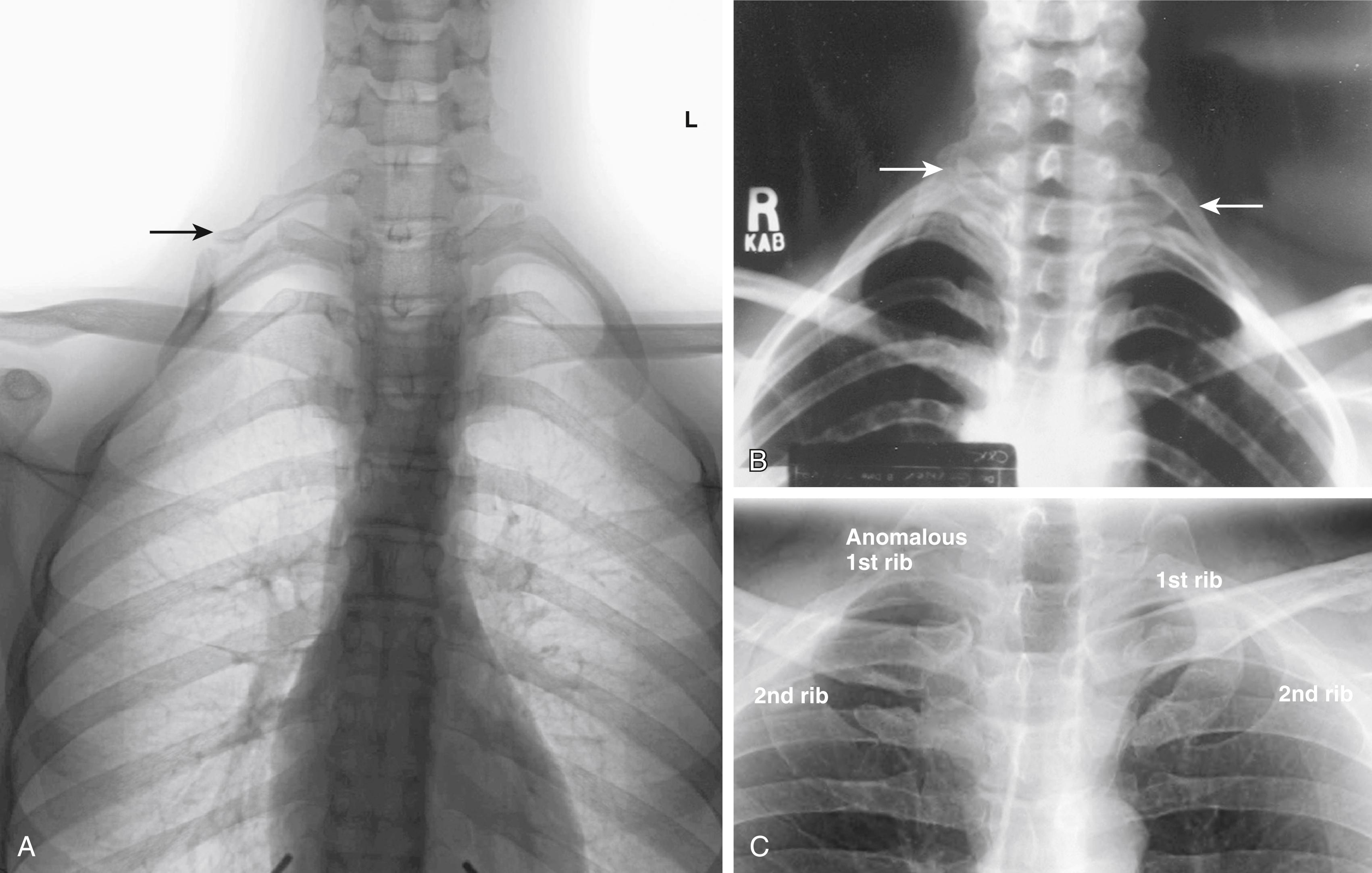 Figure 123.3, ( A ) Right complete cervical rib with a true joint between the cervical rib and a small process arising from the top of the first rib. ( B ) Bilateral cervical ribs, incomplete on the right and complete on the left. ( C ) Anomalous first rib.