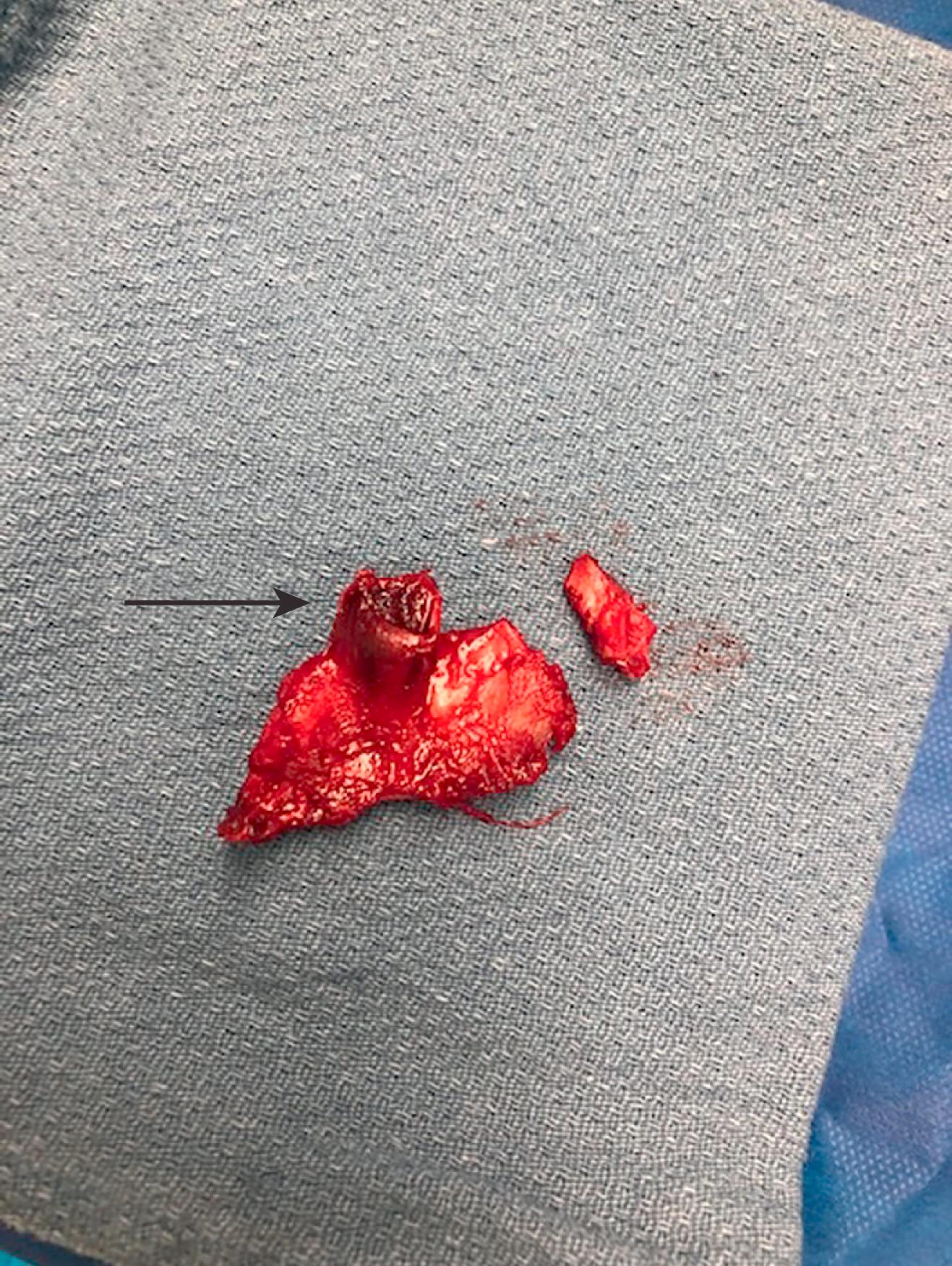 Figure 126.2, First Rib Specimen in Patient with Previous Fracture. Pseudoarthrosis ( arrow ) can be a source for venous compression and subsequent thrombosis.