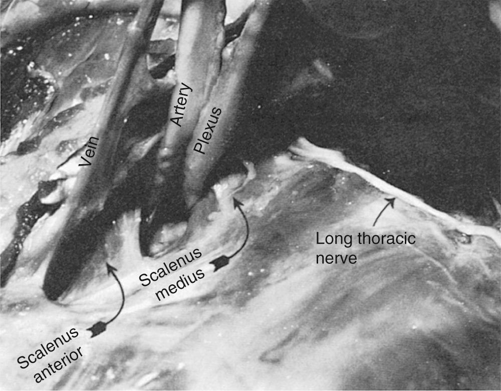 FIGURE 26-2, Anatomic dissection from the transaxillary approach, showing the relationship of the neurovascular bundle, the scalenus anterior muscle, and the long thoracic nerve along the posterior border of the scalenus medius muscle.