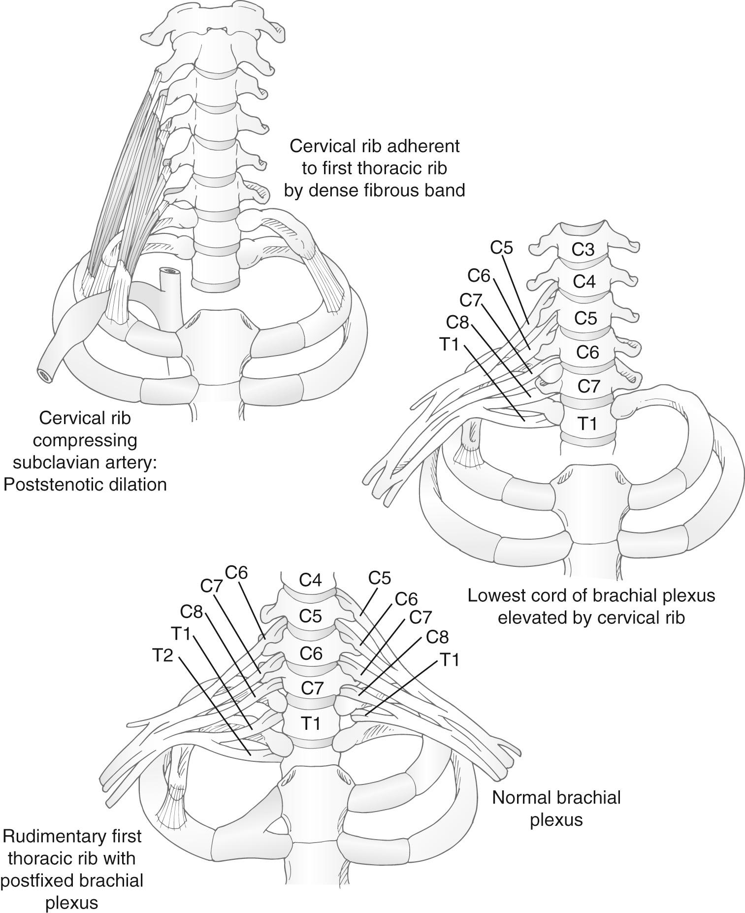 FIGURE 26-4, Compression caused by congenital rib abnormalities.