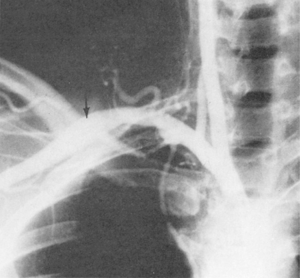 FIGURE 26-5, Arteriogram showing poststenotic dilation (arrow) of the right subclavian artery secondary to thoracic outlet compression.