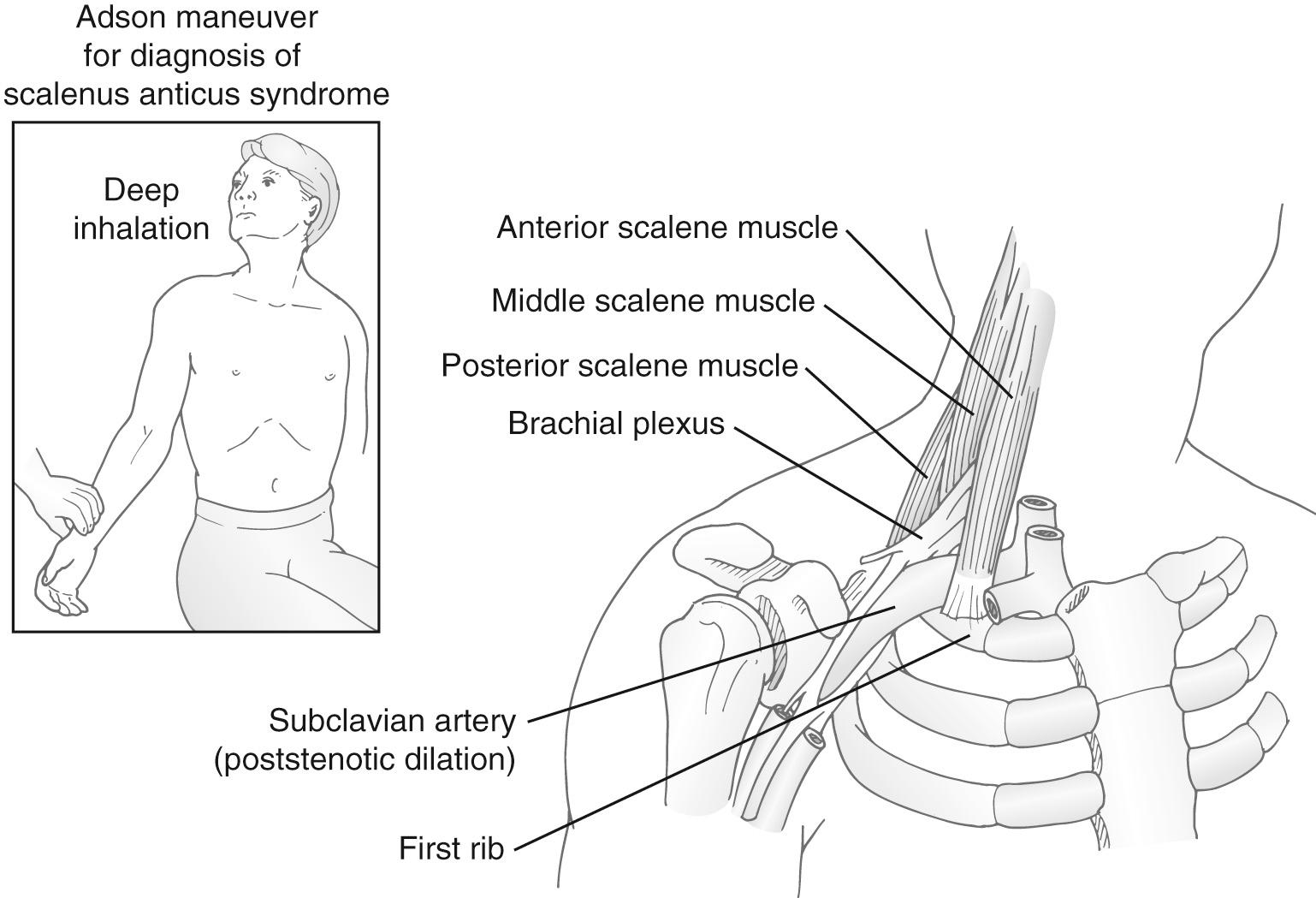 FIGURE 26-6, Adson maneuver. Relationship of the scalene triangle to the neurovascular bundle.