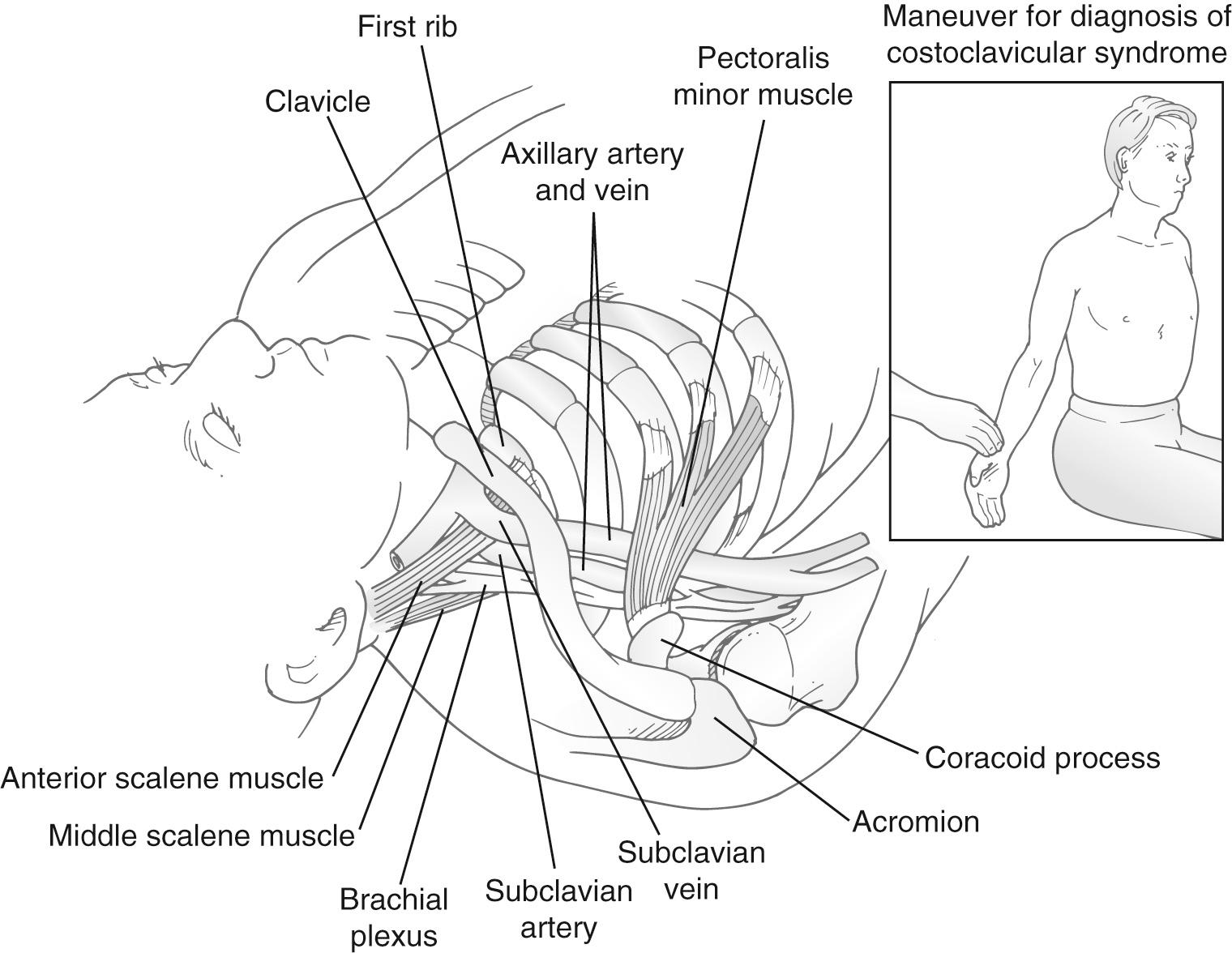 FIGURE 26-7, Costoclavicular maneuver (military position). Relationship of the costoclavicular space to the neurovascular bundle.