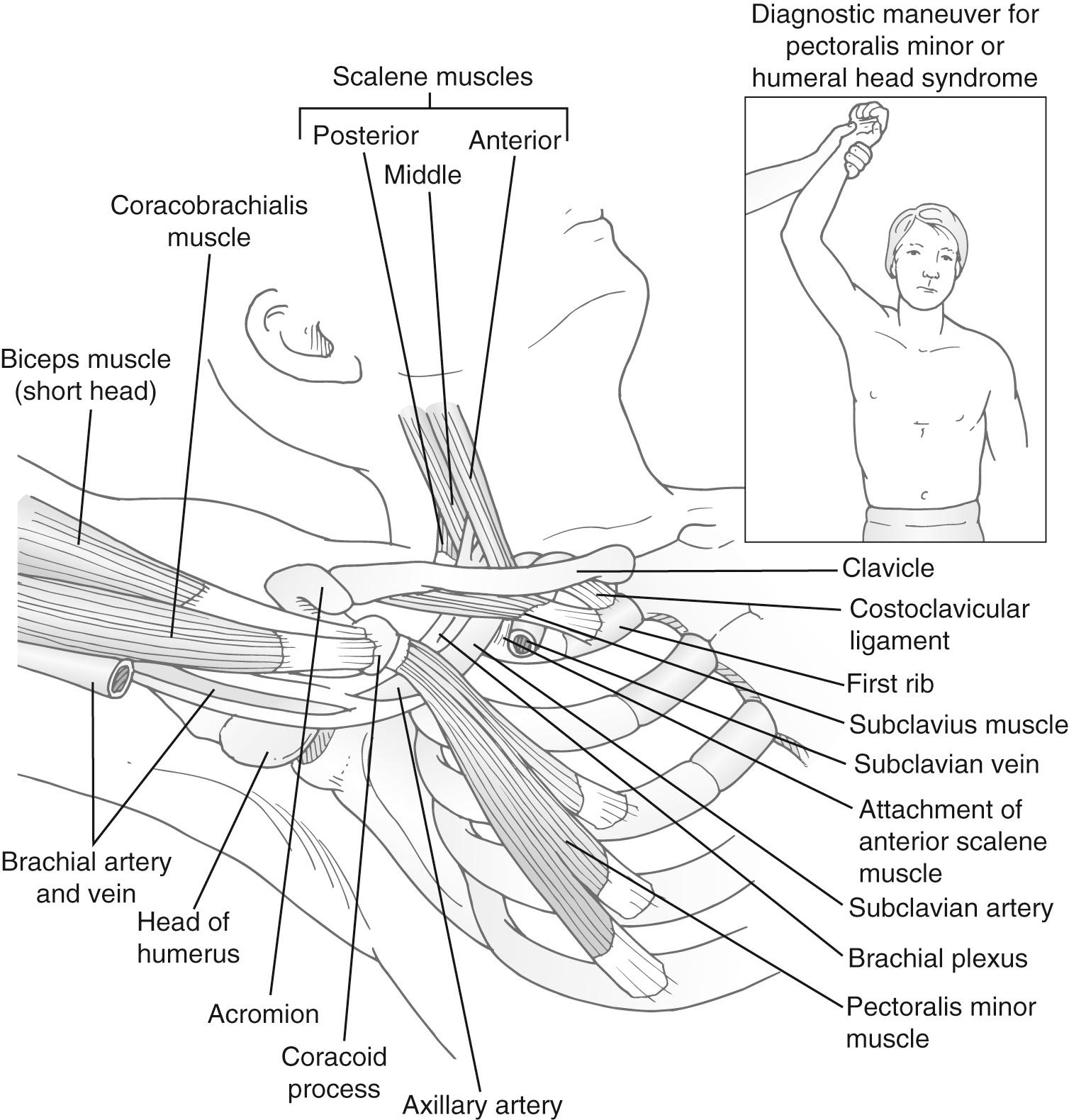 FIGURE 26-8, Hyperabduction maneuver. Relationship of the neurovascular bundle to the pectoralis minor tendon, the coracoid process, and the humeral head (pulley effect).