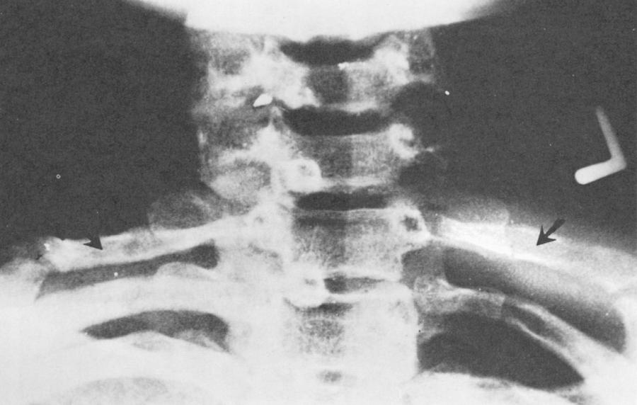 FIGURE 26-9, Radiographic film showing bilateral cervical ribs (arrows).