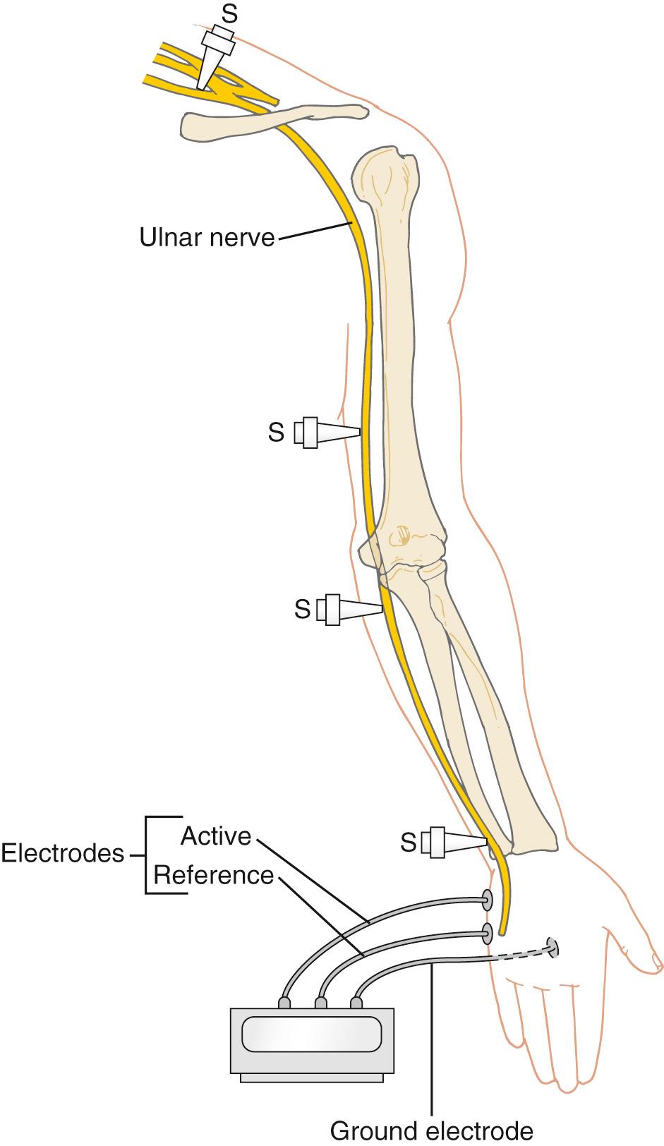 FIGURE 26-10, The four ulnar nerve stimulation points: in the supraclavicular fossa (Erb point over the trunks of the plexus), above the elbow, below the elbow, and at the wrist.