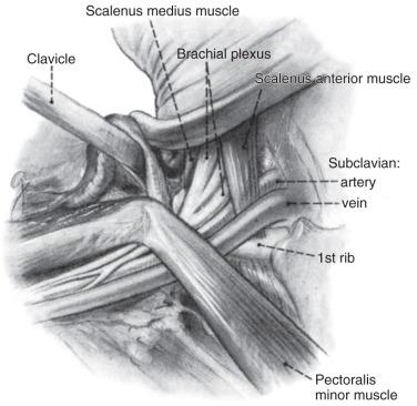 FIG 33.1, Anatomic dissection showing the anatomy at the thoracic outlet. The cadaver's head is turned to the left, and the clavicle is reflected laterally.