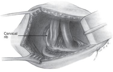 FIG 33.2, Appearance of the scalenus minimus abnormality from the transaxillary surgical approach.