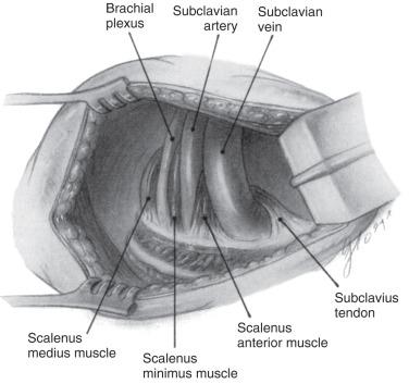 FIG 33.3, View of a fibrocartilaginous band from the tip of the right-sided seventh cervical transverse process from the transaxillary surgical approach. This abnormality can compress the brachial plexus and subclavian artery, causing symptoms identical to those resulting from a cervical rib. The fibrocartilaginous band commonly occurs with an elongated C7 transverse process and represents partial formation of a cervical rib.