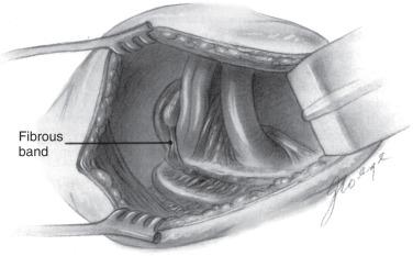 FIG 33.4, View of thoracic outlet structures from the transaxillary surgical approach. The brachial plexus and subclavian artery are compressed and displaced by a right-sided cervical rib. This cervical rib articulates in the center of the first thoracic rib.